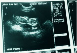 12周b超胎盘位于子宫前壁0级,16周b超显示胎盘成熟0级