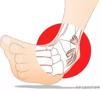 打球崴脚急救措施,打球崴脚了肿了怎么办