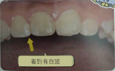 为什么牙齿会蛀牙儿童科普,儿童牙齿长白点是蛀牙吗