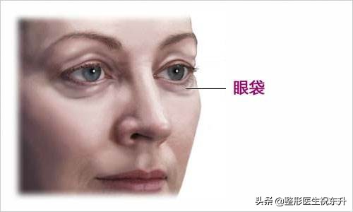 眼袋黑眼圈泪沟卧蚕的区别,有泪沟黑眼圈无眼袋卧蚕不见