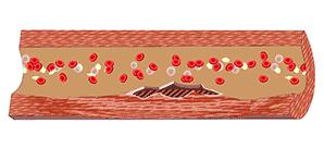 血管堵塞动态图片,血管疏通动图