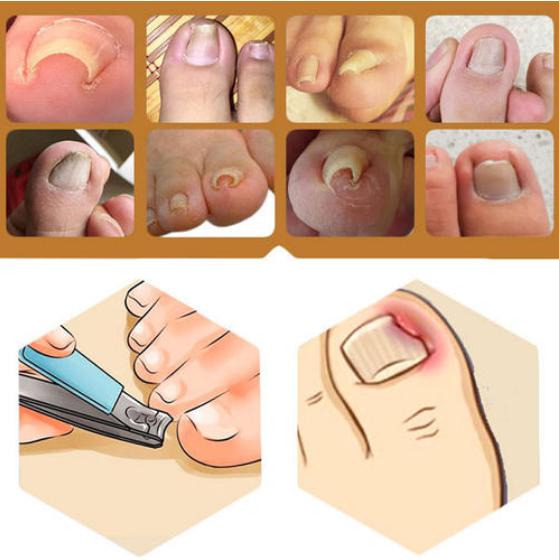 甲沟嵌甲从根部戳到肉里面怎么办,脚趾甲侧面嵌甲自己怎么处理