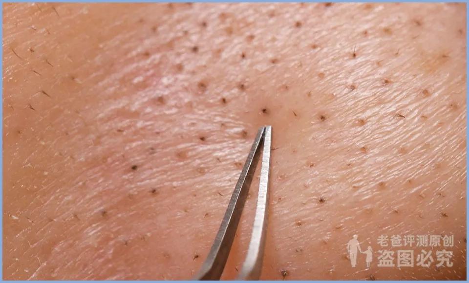 黑头怎么从根部去除,黑头到底怎么去