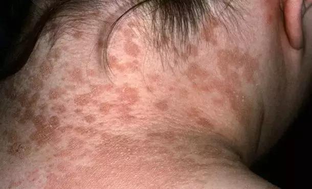 婴儿脖子皮肤比较黄是啥原因,婴儿脖子上起鸡皮是怎么回事