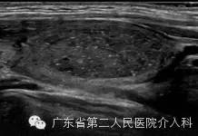 甲状腺良性腺瘤做消融好吗,甲状腺囊性腺瘤用做手术吗