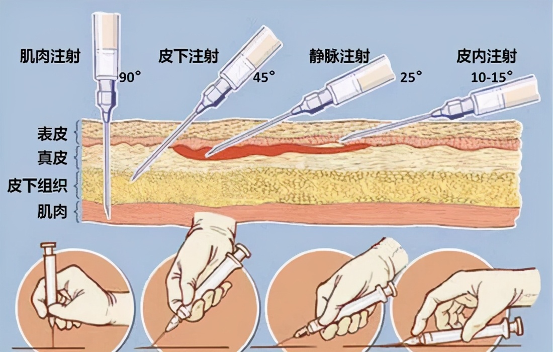 打屁股针为什么这么疼？为什么打针通常都打在屁股上，因为肉多？