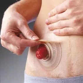 造口凹陷回缩护理视频,造口回纳术后的护理方法