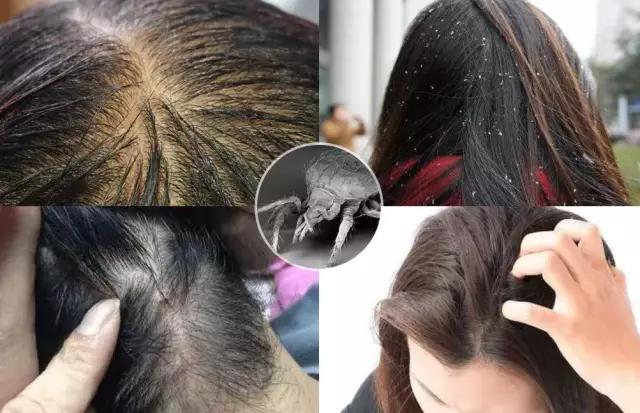 头皮痒出油有螨虫怎么解决,头皮痒出油起螨虫怎么办