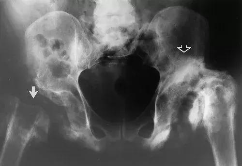 神经性骨关节病,神经性关节炎症状图片