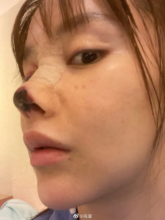 隆鼻的几大风险,隆鼻真的10个做9个后悔吗