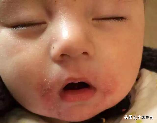 口水疹是什么原因引起的,为什么宝宝口水疹反复