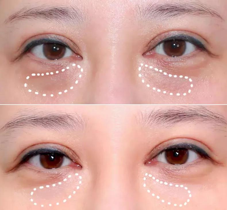 治眼袋三个小妙招快速去眼袋,上眼袋大最简单的去眼袋的方法