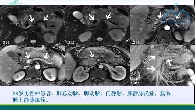 急性胰腺炎的护理措施,急性胰腺炎影像与临床