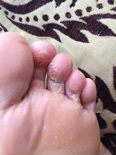 治疗脚气用什么药泡脚比较好,脚气怎么治疗用什么药效果好