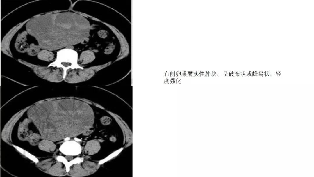 卵巢原发肿瘤的分析思路