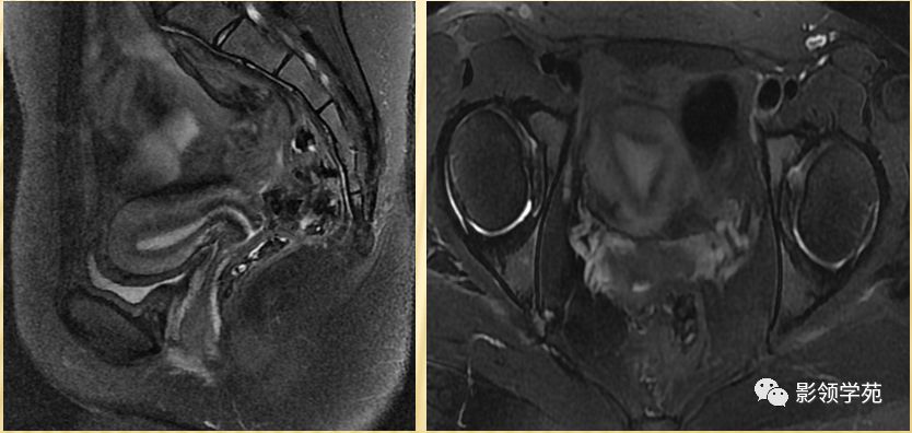 宫颈癌mri诊断,宫颈癌的mr扫描技术