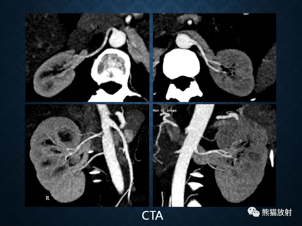 纵隔和肾上腺恶性肿瘤,纵隔性肿瘤位置图