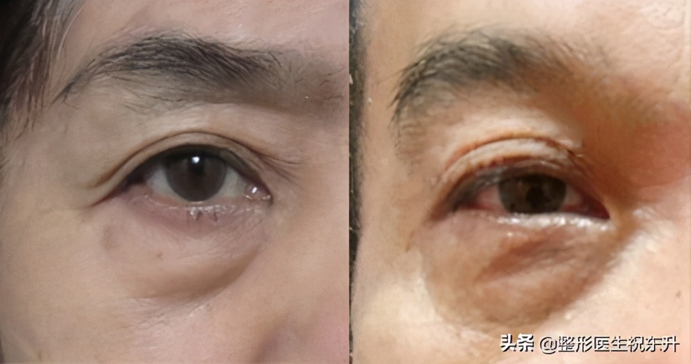 外切祛眼袋多久恢复自然,外切去眼袋手术有危险吗