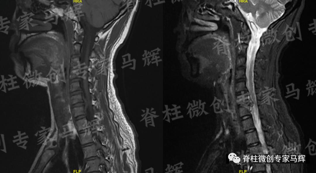 脊椎狭窄压迫神经腿疼怎么治疗,神经根痛上肢麻木怎么康复