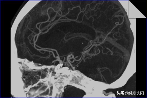 cta和血管造影怎么选择,血管oct检查与血管造影检查的区别