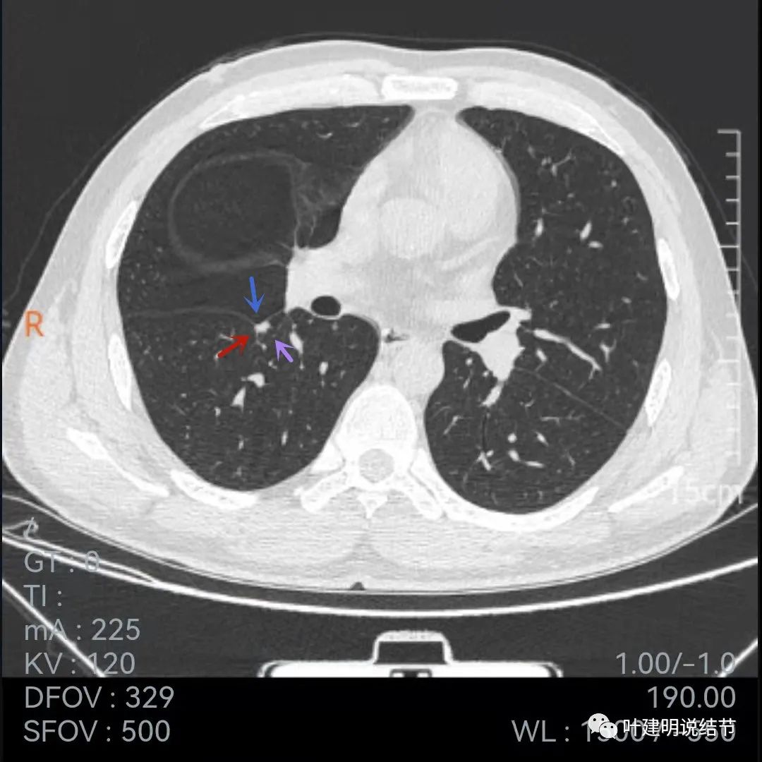 问诊分析:存在了4年的实性结节会不会是肺癌?