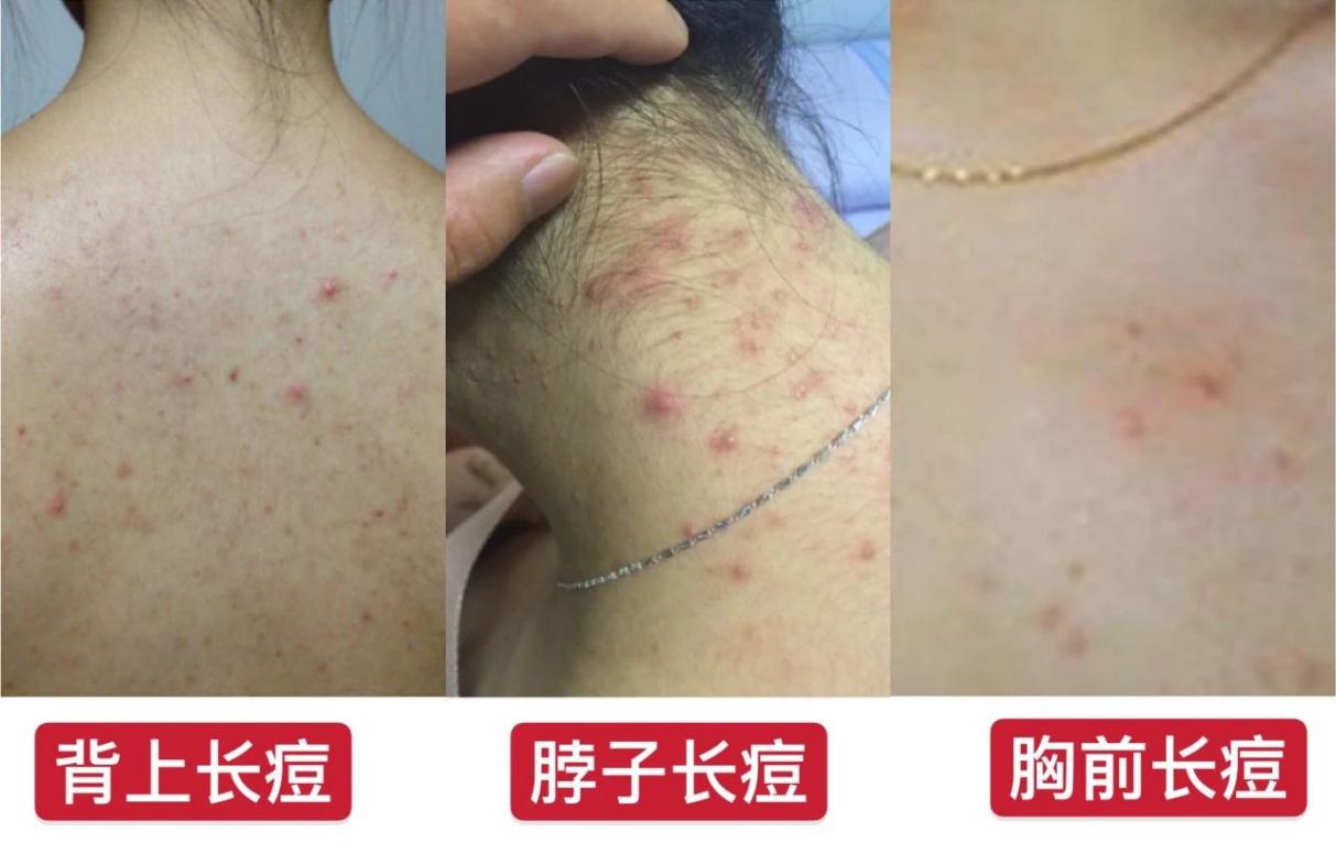 脸油痘痘多黑头用什么简单洗干净,清理黑头痘痘的最简单方法