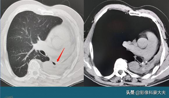 22岁查出癌症放弃治疗,医生自述得癌症放弃治疗