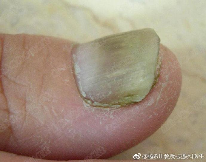 指甲问题对应身体哪里有问题,指甲的各种病变及解决办法