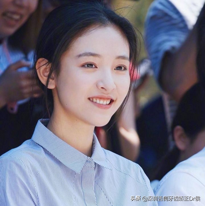 露龈笑原因,露龈笑矫正