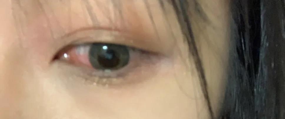 儿童角膜溃疡严重会穿孔吗,儿童角膜溃疡