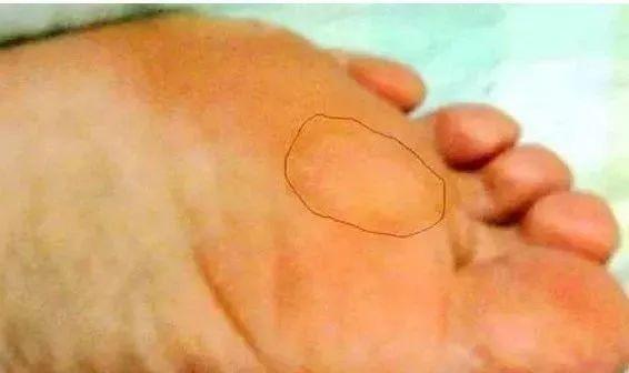 脚上老皮、老茧不用慌，教你一招小妙方！发给需要的人