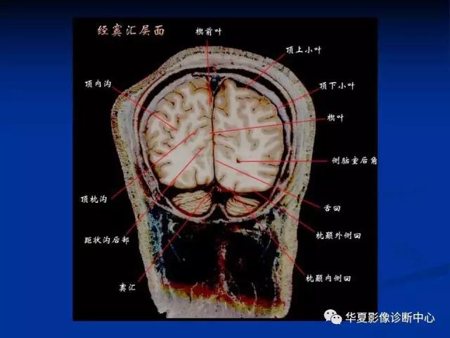 电子版头颅ct与mri断层解剖,头颅mri血管解剖与分段详解