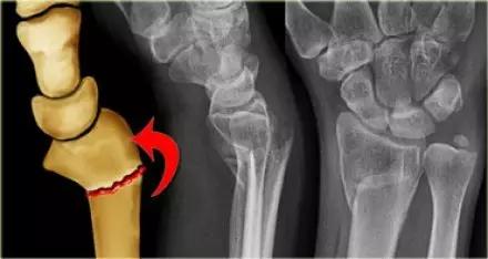 几种严重骨折医学名称,常见的骨折有哪些名称