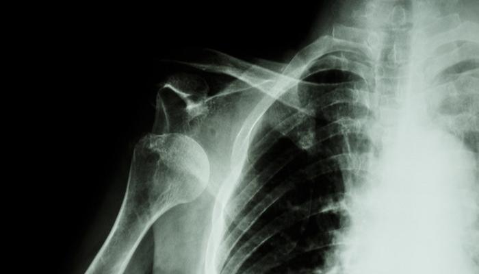 肩关节脱位患者需进行复位治疗，警惕再脱位的发生，给予制动治疗