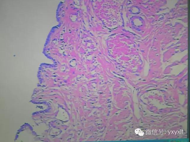 苗勒氏管囊肿在哪里,苗勒氏管囊肿是指什么