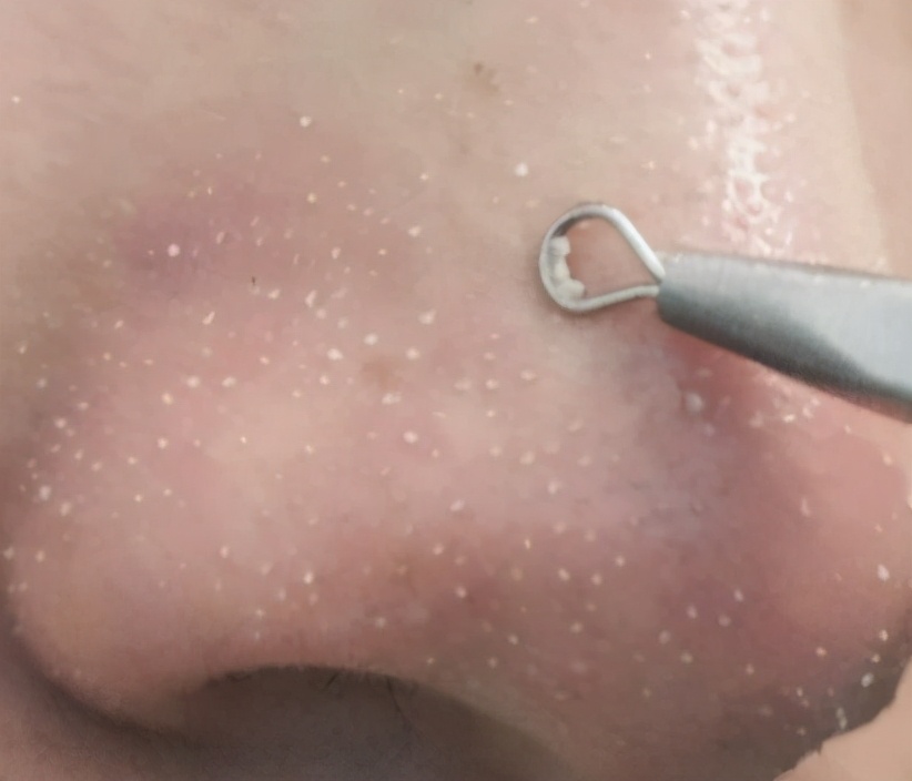 黑头被堵在毛孔里挤不出来怎么办,黑头已经出来了但是毛孔还是黑的