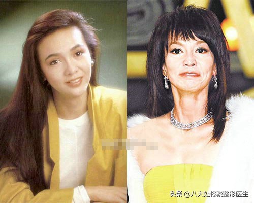 为什么注射玻尿酸会淤青,玻尿酸僵尸脸