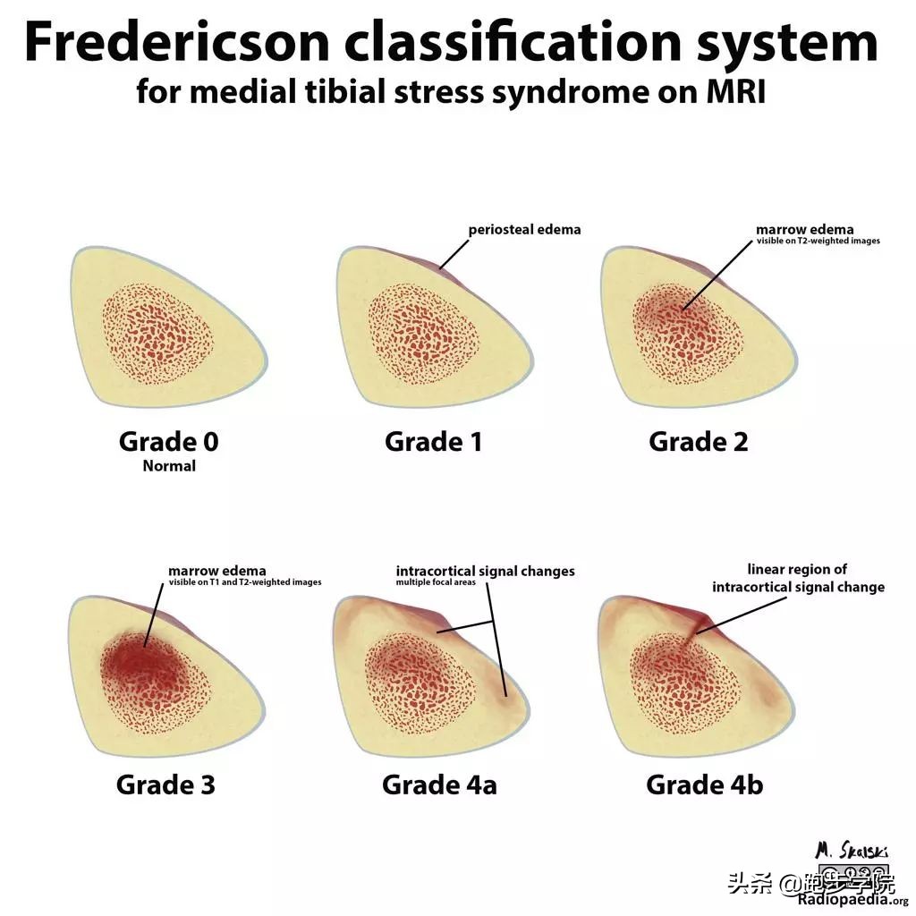 伤害了1/3跑者的胫骨炎,请务必重视起来