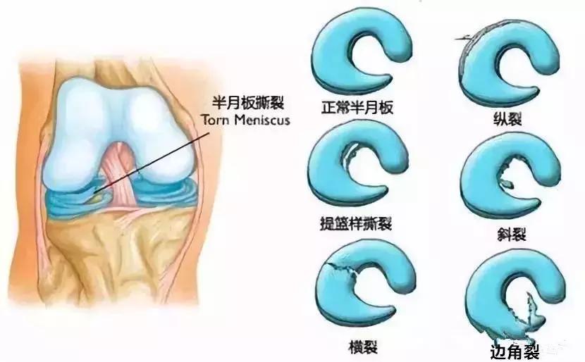 常见足球运动损伤及处理方法教案,常见的足球运动损伤的预防及治疗