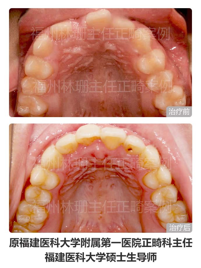 牙齿矫正仍然没整齐,异位正常牙齿矫正不过来怎么办