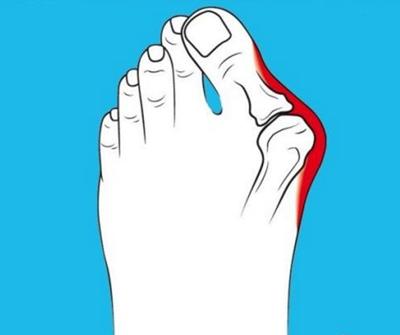 拇外翻大脚趾死皮厚,大脚趾拇外翻怎么处理