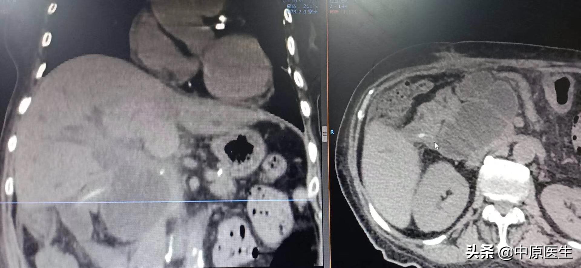 团队工作：老太太患黄疸规范治疗后仍高烧，转到介入科很快治好了