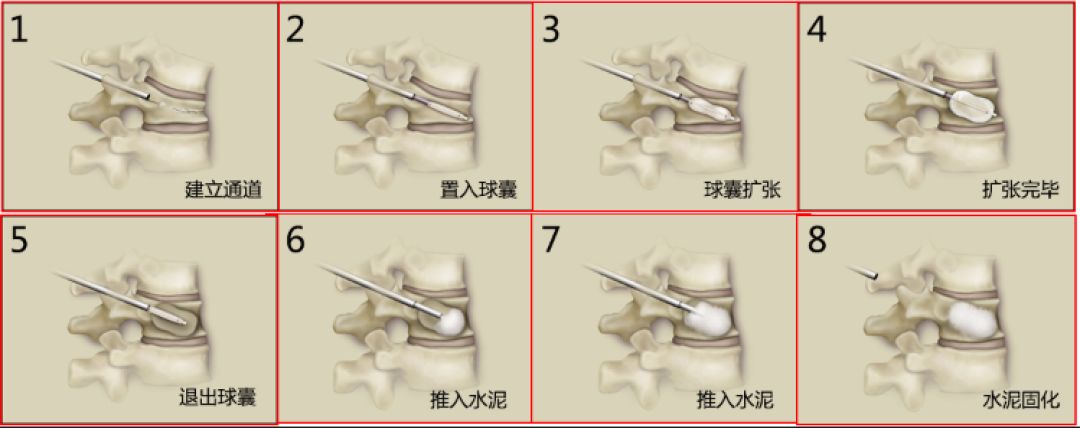 腰椎压缩骨折椎体成形术啥时候做,骨质疏松骨折椎体成形术操作步骤