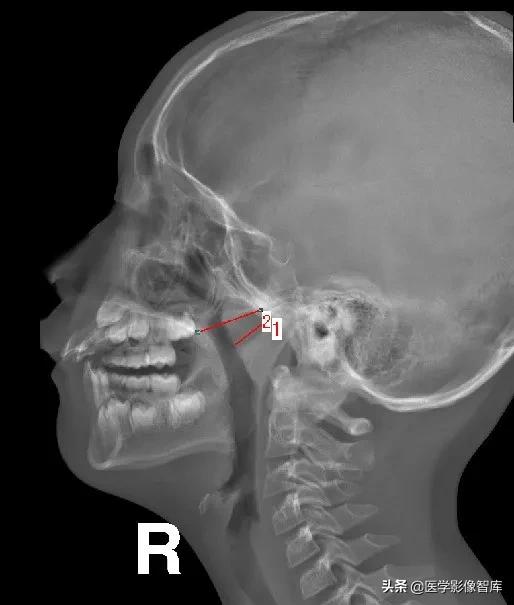 腺样体肥大有必要做x射线复查吗,最简单检测腺样体肥大的方法