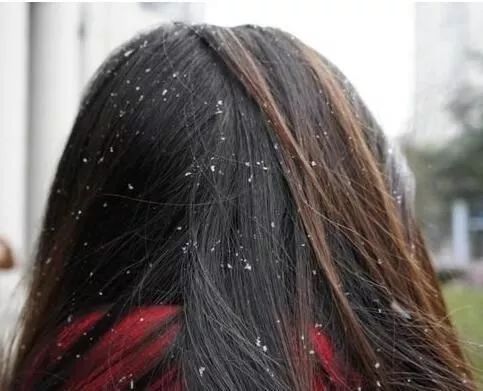 有头皮屑头痒用什么药治,头皮屑多头痒用啥洗发水