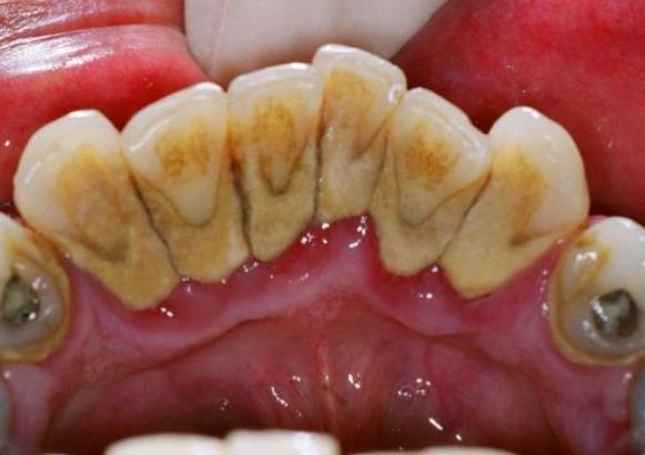 牙缝里黑色污垢是蛀牙吗,牙缝里黑垢能洗掉吗