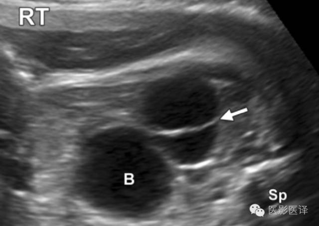胎儿卵巢囊肿5.6厘米会消失吗,卵巢巨大囊肿与妊娠鉴别