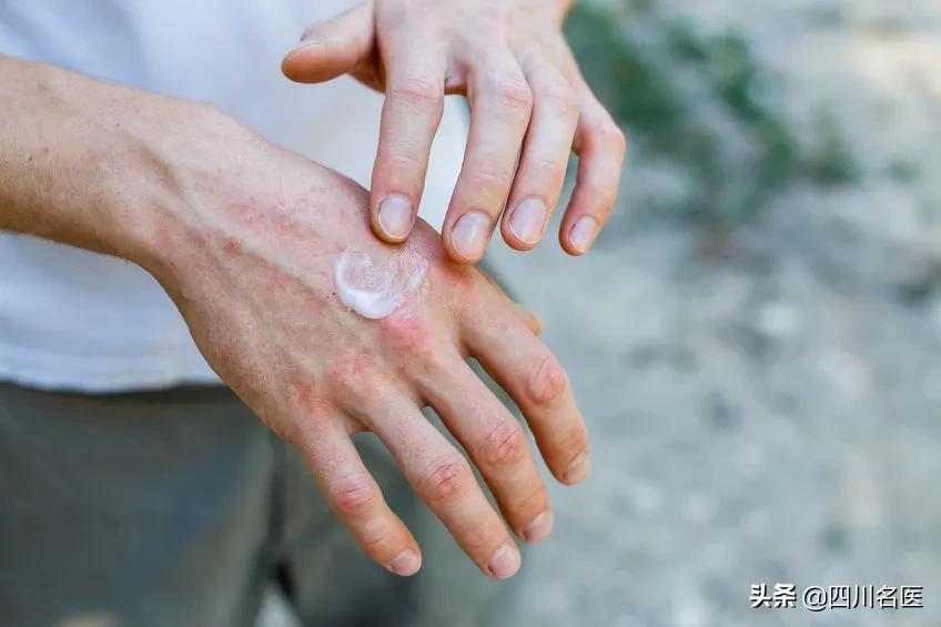 一到夏天手上起小水泡痒注意事项,手上长小水泡可能是什么原因引起