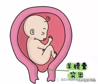 医生为宫颈机能不全的她“关上”宫颈口，“打开”生命的希望