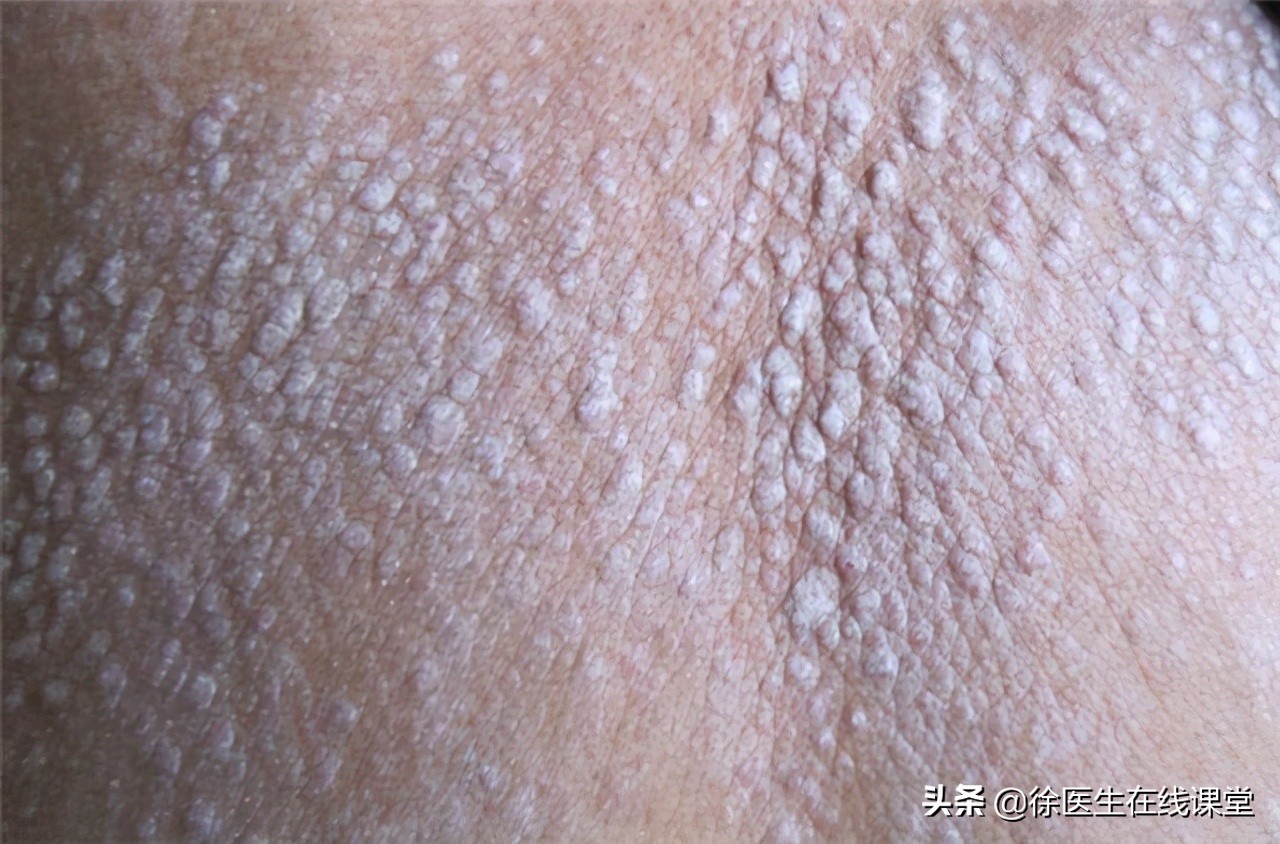 甲硝唑是便宜的和贵的有什么区别,甲硝唑便宜的和贵的有什么区别